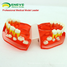 DENTAL16 (12596) Modelo dentário de desenvolvimento dentário da faixa etária dos 3 aos 6 anos de idade